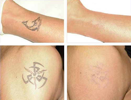 tattoo_removal